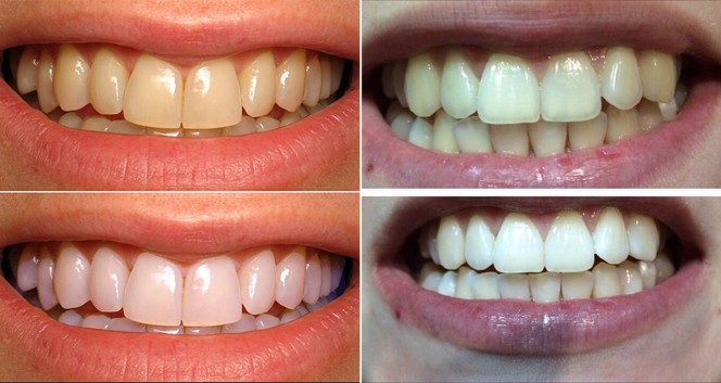 восстановление эмали отбеливание зубов